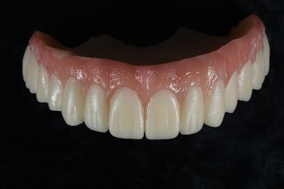 Začasna krona iz akrilne smole